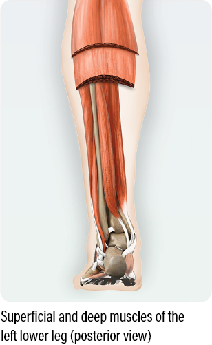 medical diagram with a posterior view showing how to dose and administer dysport for superficial muscles of the left lower leg in adults with lower limb spasticity