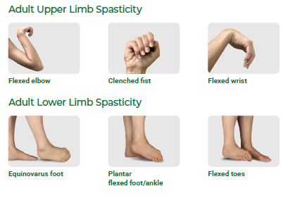 Are you experiencing the signs and symptoms of spasticity?